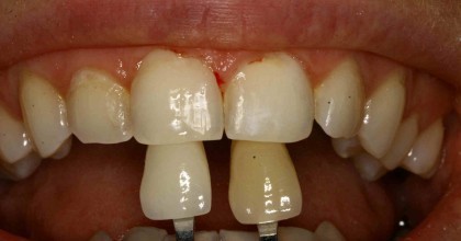 Efekt po Przed zabiegu wybielania pojedynczego zęba